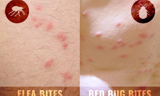 bed bug bites and flea bites